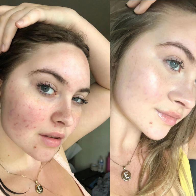 LiftGlow™ - Face Lifting Massager