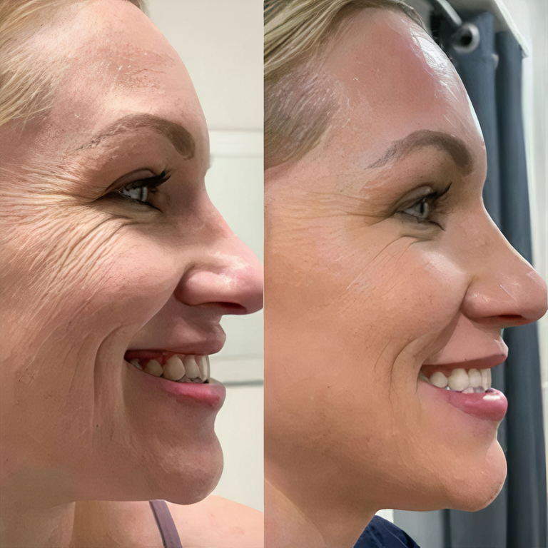 LiftGlow™ - Face Lifting Massager